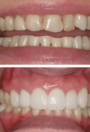 Before and After Smile Image
