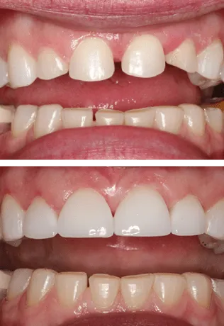 Before and After Smile Image