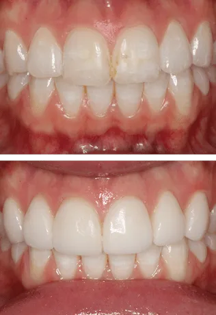 Before and After Smile Image