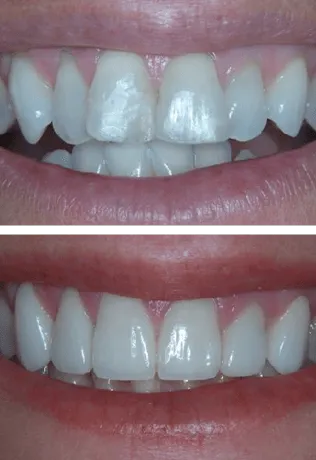 Before and After Smile Image