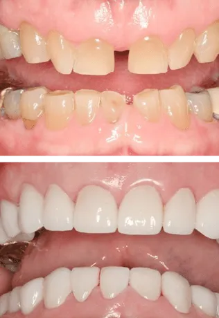 Before and After Smile Image