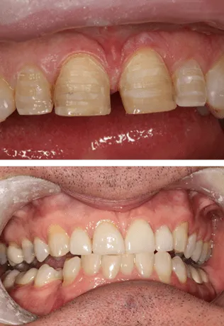 Before and after veneers