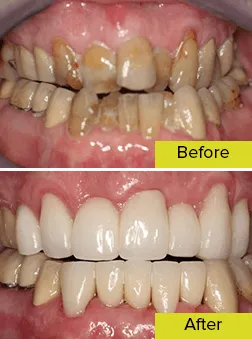 teeth before and after rehabilitation