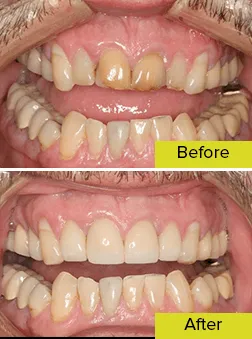 teeth before and after rehabilitation