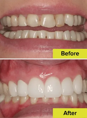teeth before and after rehabilitation